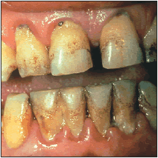 Periodontitis Periodontitis