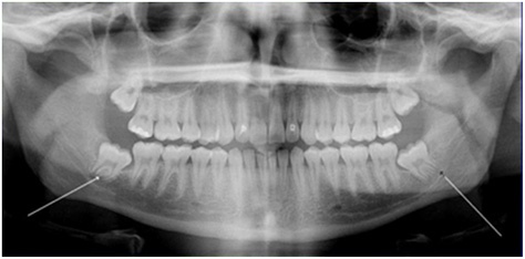 X-ray of wisdom teeth